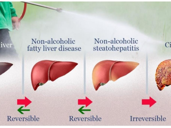 Dah Kurus, Tapi Apa Kes Wanita Hati Berlemak?