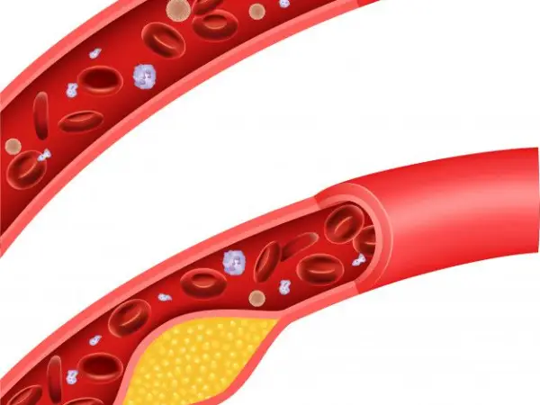 Turunkan Kolestrol Dengan Resveratrol Dan Polifenol