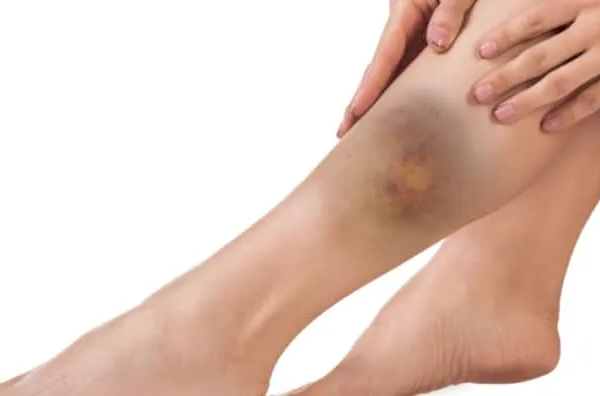 Kenapa Badan Mudah Lebam Tanpa Sebab? Ini 7 Punca Utama!