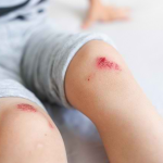 Luka Tak Kering Walau Dah Letak Ubat? Ini Penjelasan Saintifiknya