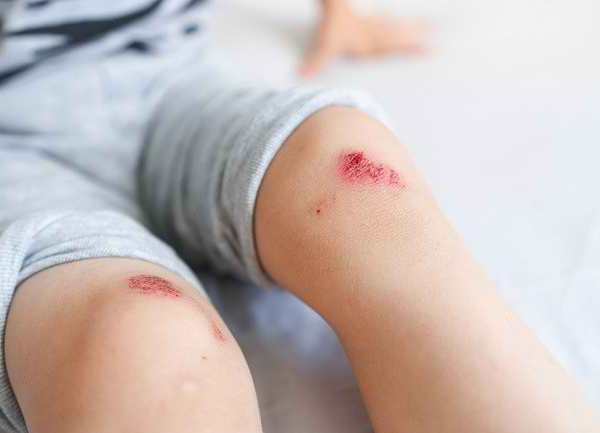 Luka Tak Kering Walau Dah Letak Ubat? Ini Penjelasan Saintifiknya