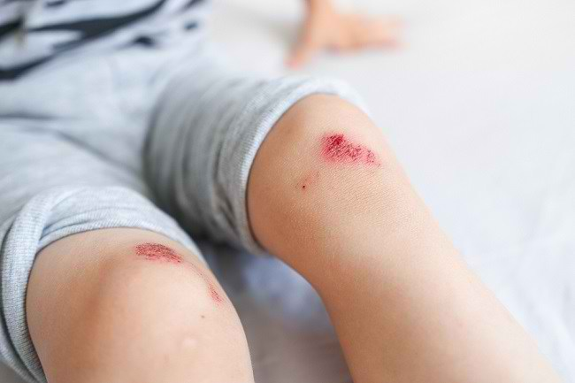 Luka Tak Kering Walau Dah Letak Ubat? Ini Penjelasan Saintifiknya