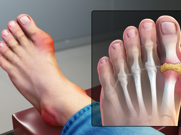 Kenapa Sendi Selalu Sakit? Ketahui Hubungannya Dengan Gout